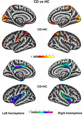 Cortical and Subcortical Structural Abnormalities in Patients With Idiopathic Cervical and Generalized Dystonia